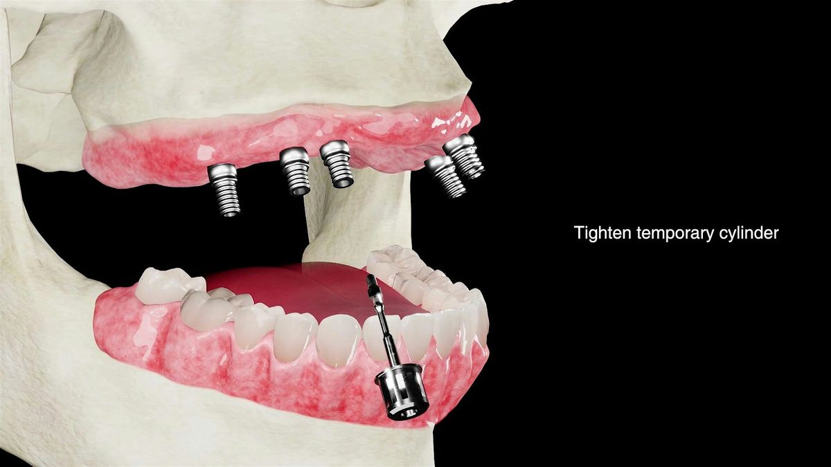 Guided Implant Placement for Full Arch Restoration