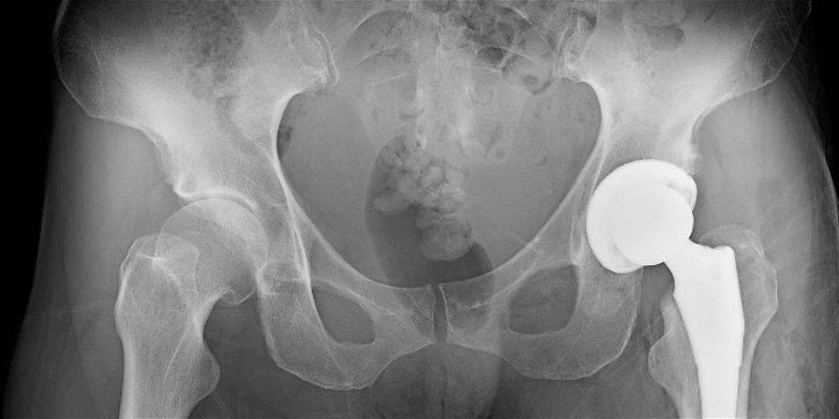 Harkness Saturday Series - Total Hip Replacement: Preparation & Recovery