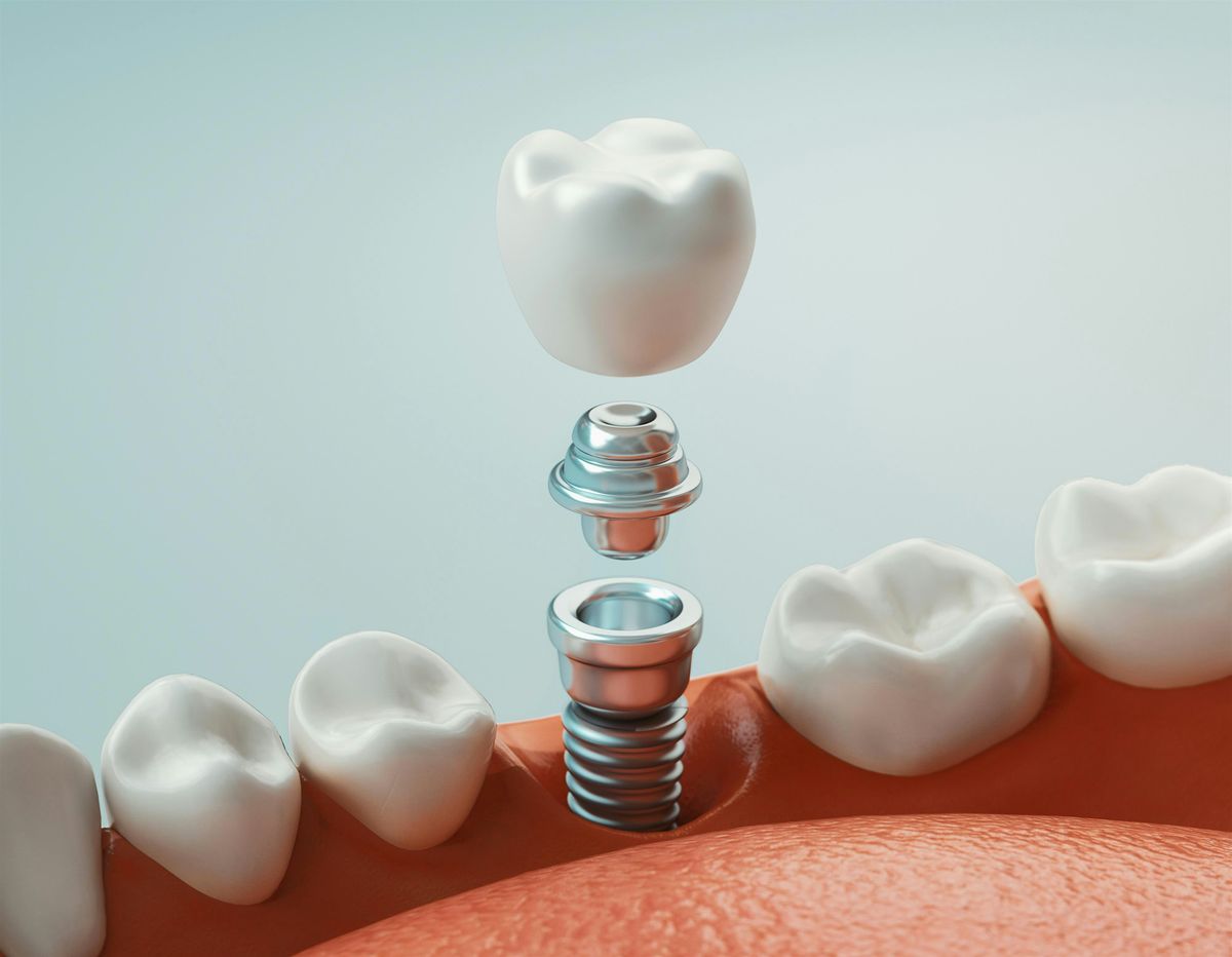 Mastering the Complexities of Implantology with Dr. Roxana Saldarriaga