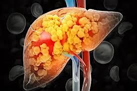 Metabolic Matters-MASLD in Obesity: Early Detection and Management