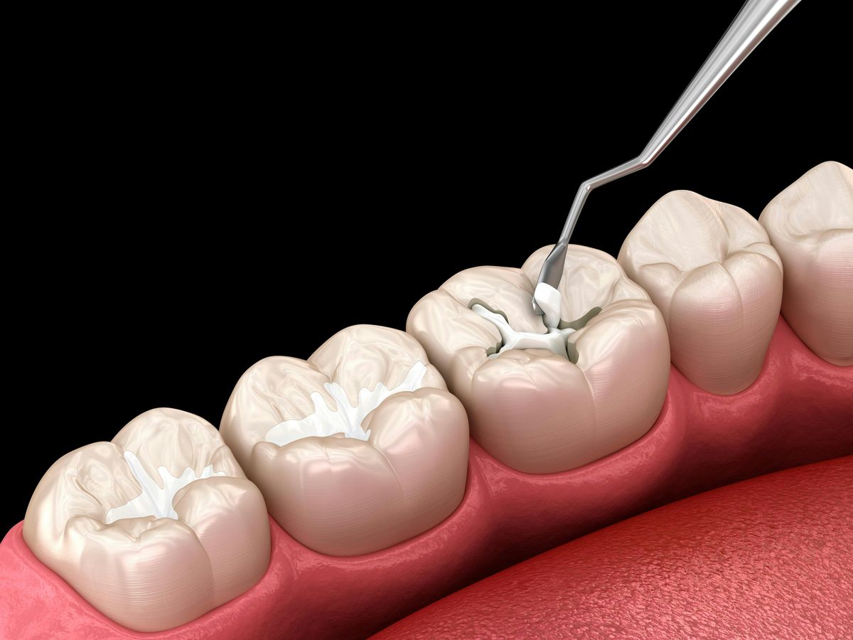 3M -Restorative Materials and Matrix Use