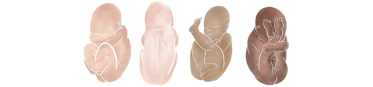 Physiological Breech Birth Training Day - Stoke Madeville