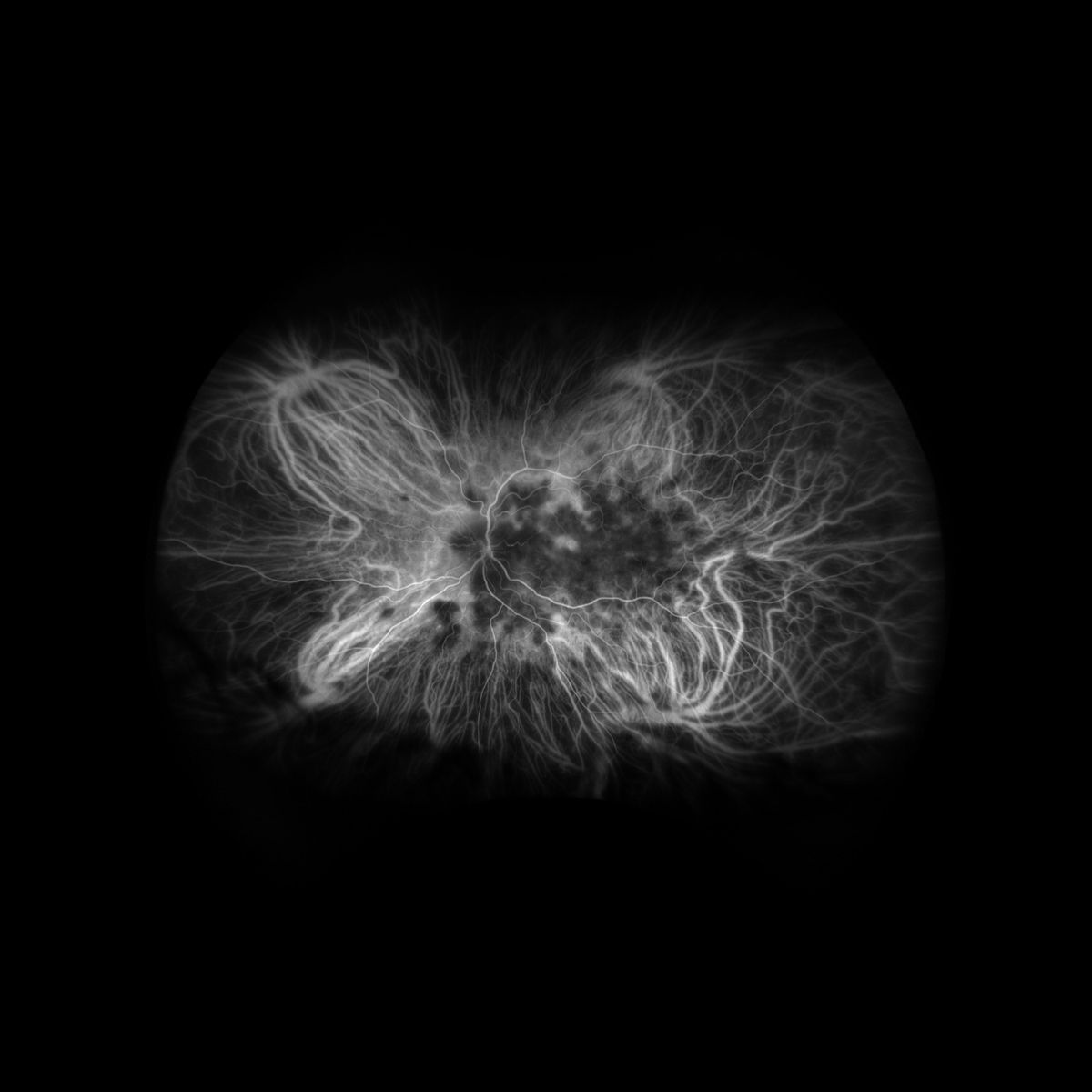 2025 Retina Update for the Optometrist