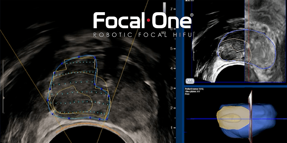 Focal Therapy Expert Panel & Dinner during SUO 2025