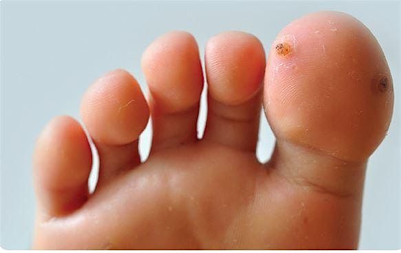 Verruca Needling - CPD