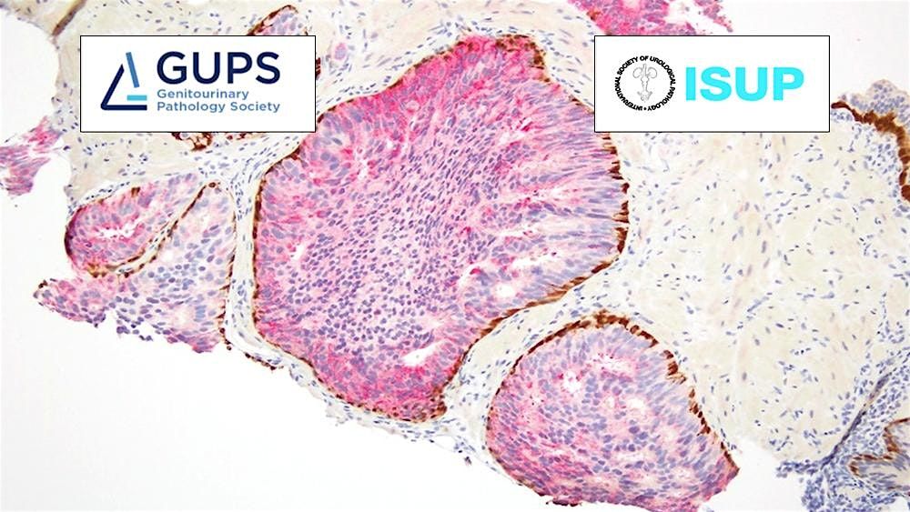 Expert Consultation Conference on Intraductal Carcinoma of the Prostate