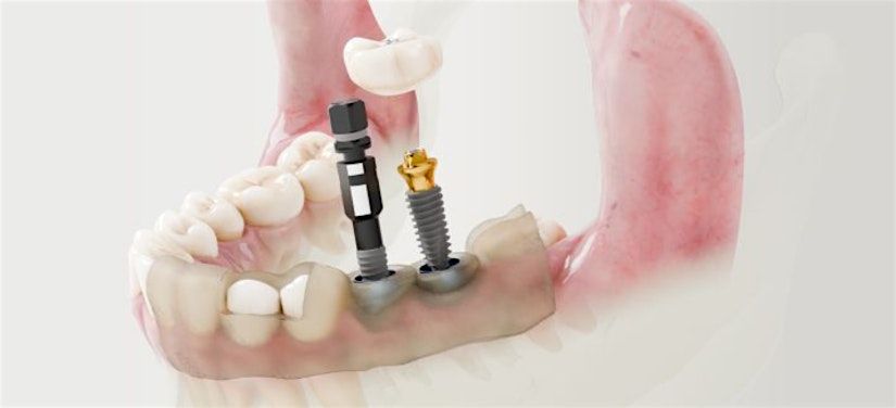 Introduction to Guided Implant Workflow - San Antonio, TX I Dec 13, 2024