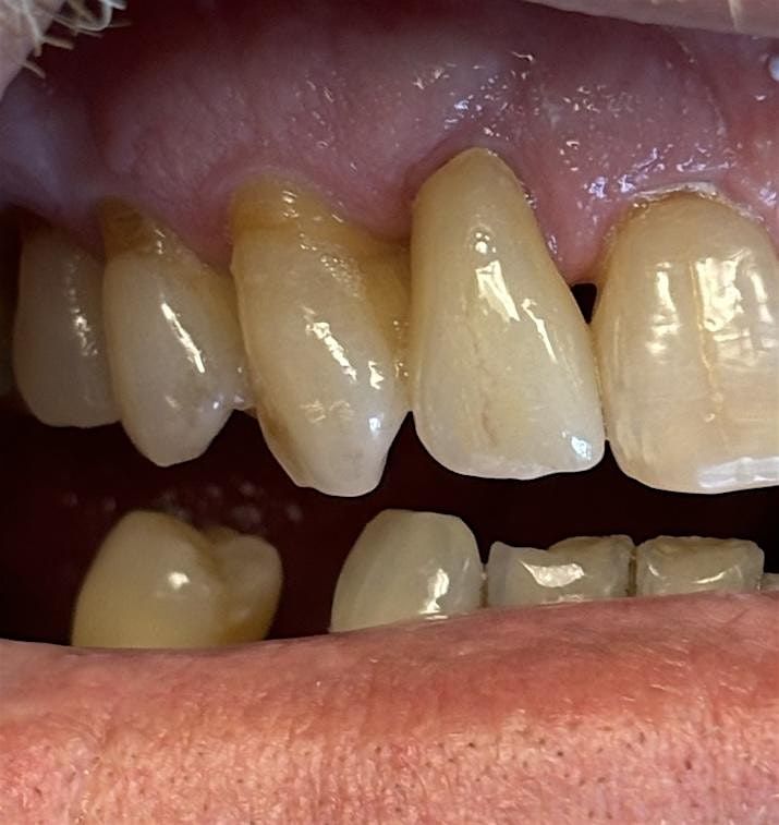MiYo-Superior Esthetics for Monolithic Crowns