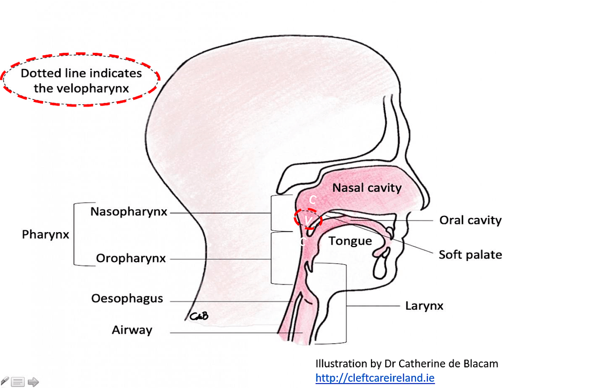 Assessment and Intervention of Cleft Palate Speech and non-Cleft VPD