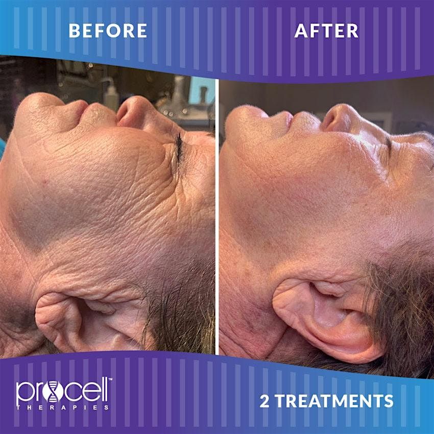 Rejuvenate your skin with Procell Microchanneling