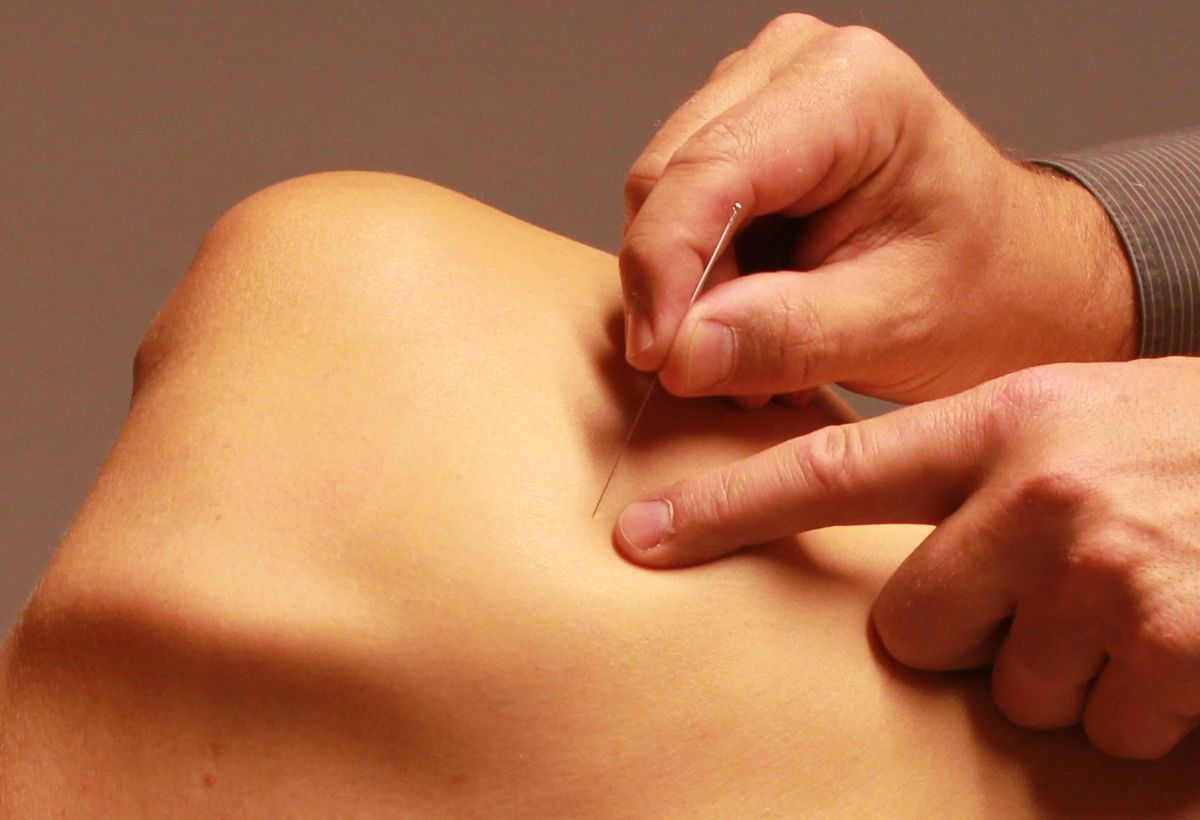 Gratis infosessie Dry Needling Trigger @Leuven