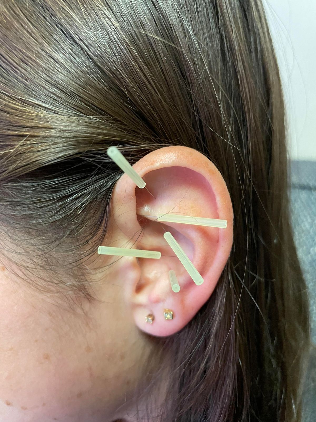 5 Point Auricular Acupuncture 