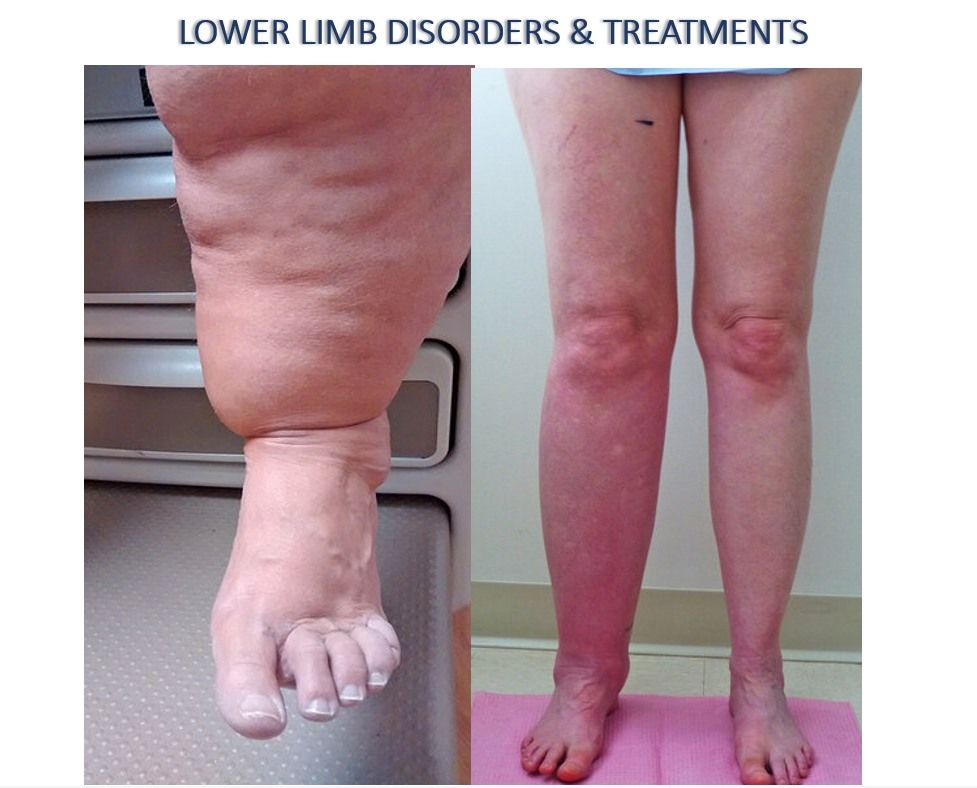 Lower Limb Disorders Injuries & Treatments (15 CPD)