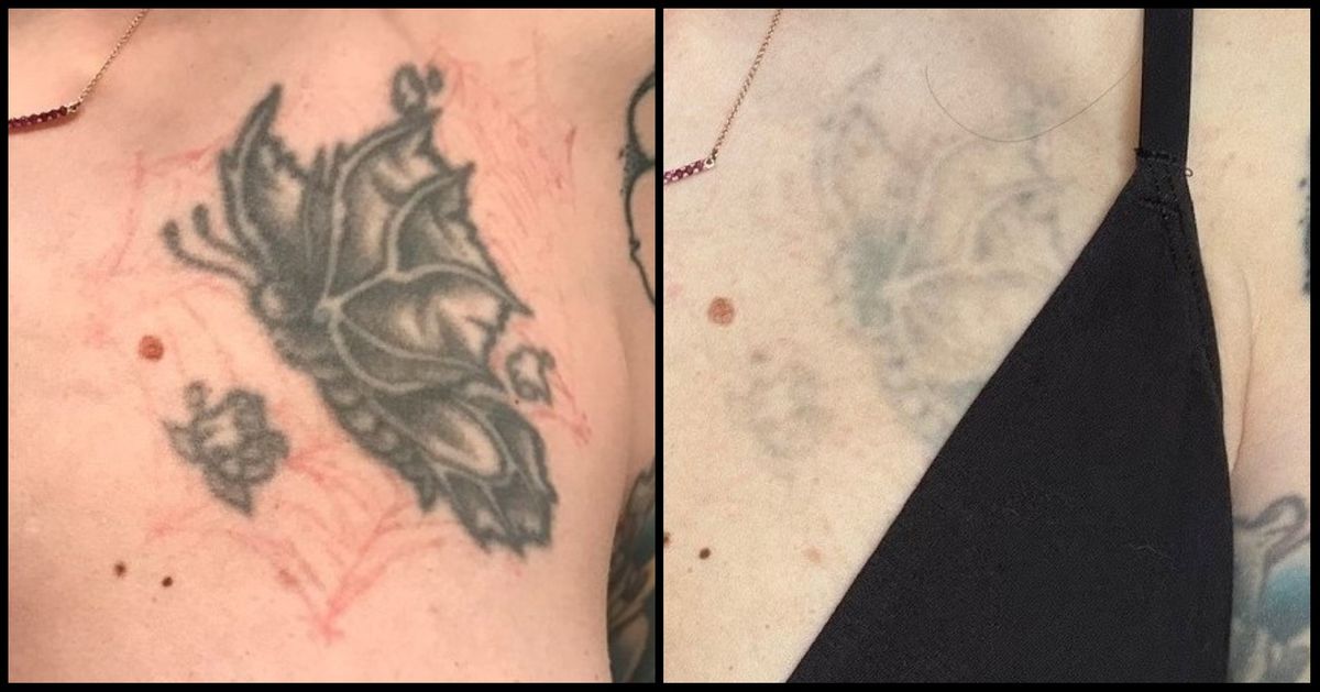 LASER TATTOO REMOVAL 