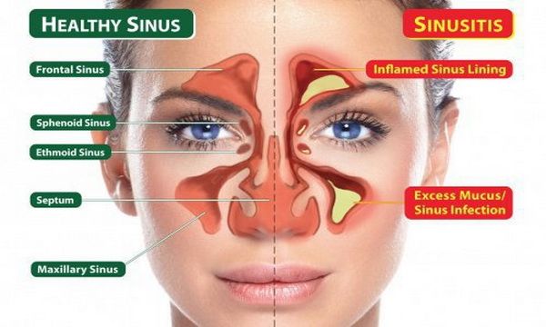 Ayurvedic Sinus Treatment; Therapeutic Nasya, Sans, Steam and Pranayama In Person or Online