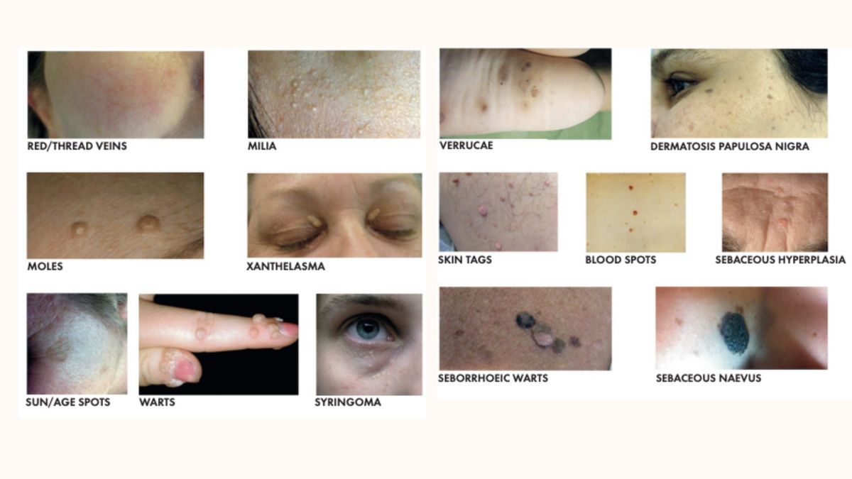 BIAE Advanced Blemish Removal - Models