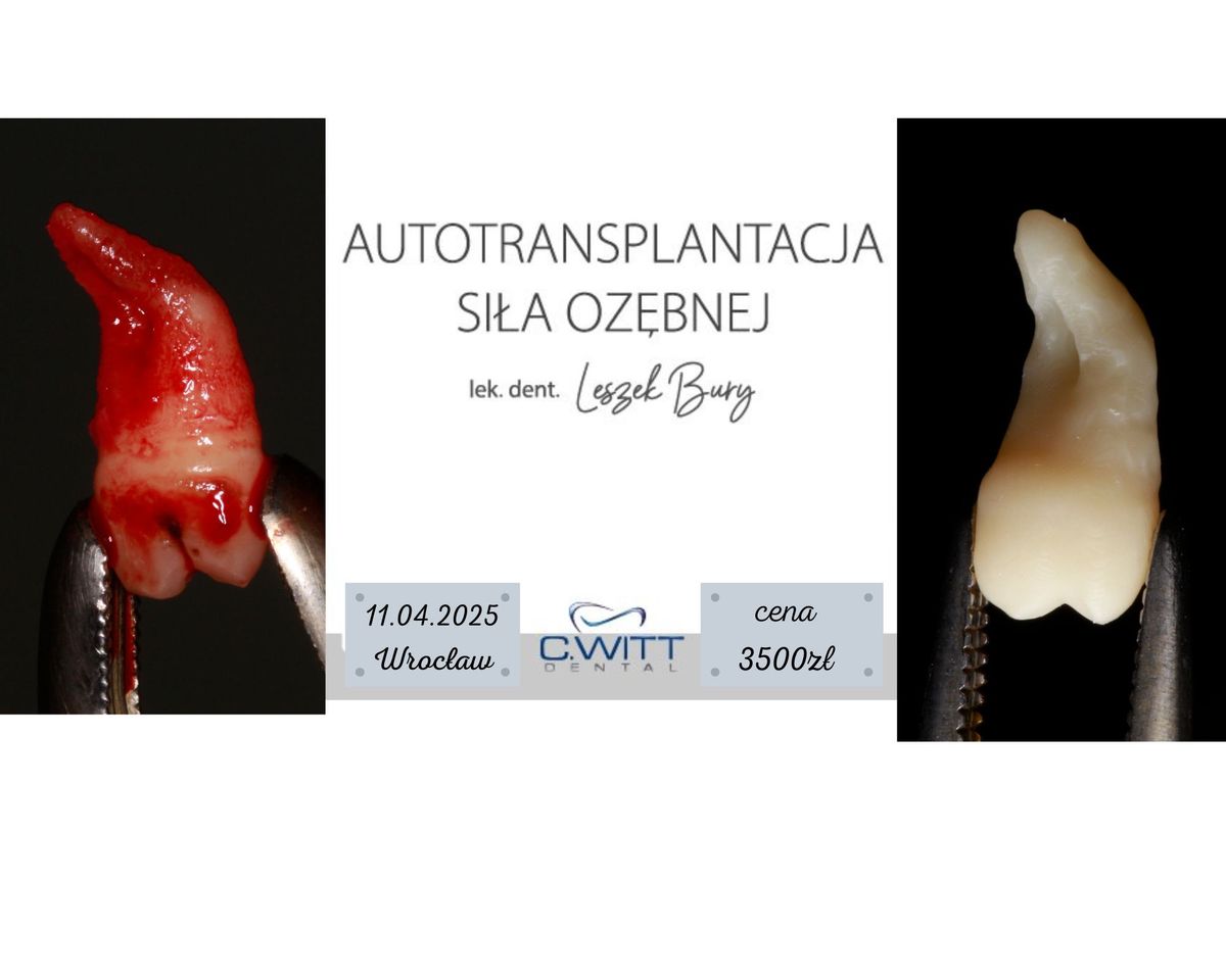 Autotransplantacja z\u0119b\u00f3w - si\u0142a oz\u0119bnej